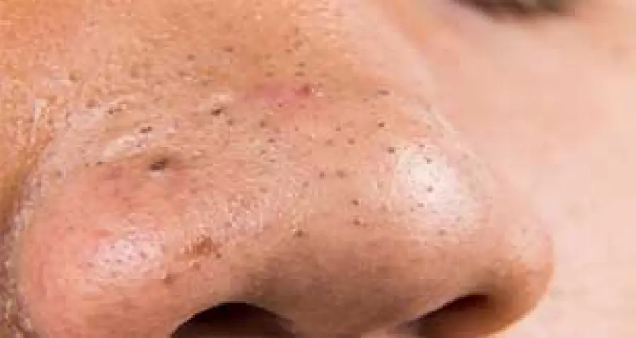 Come togliere i punti neri - Rimedi Naturali
