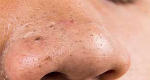Come togliere i punti neri - Rimedi Naturali