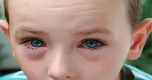 Palpebre Gonfie Bambini: Cause e Rimedi