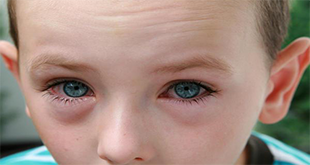 Palpebre Gonfie Bambini: Cause e Rimedi