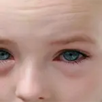 Palpebre Gonfie Bambini: Cause e Rimedi