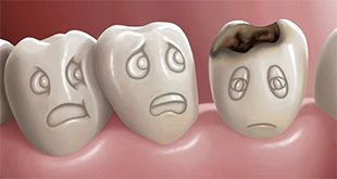 Come capire se un dente è cariato