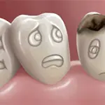 Come capire se un dente è cariato