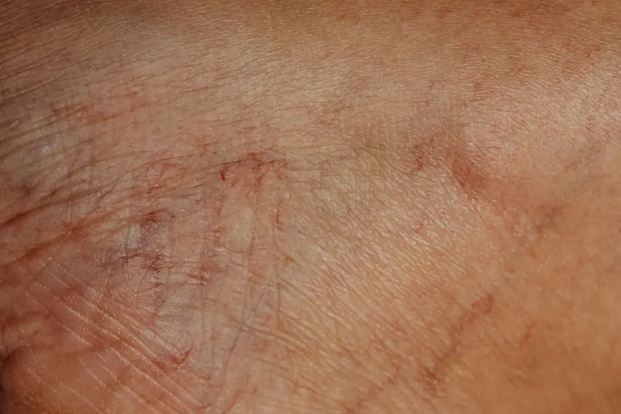 Orticaria: sintomi, cause e rimedi