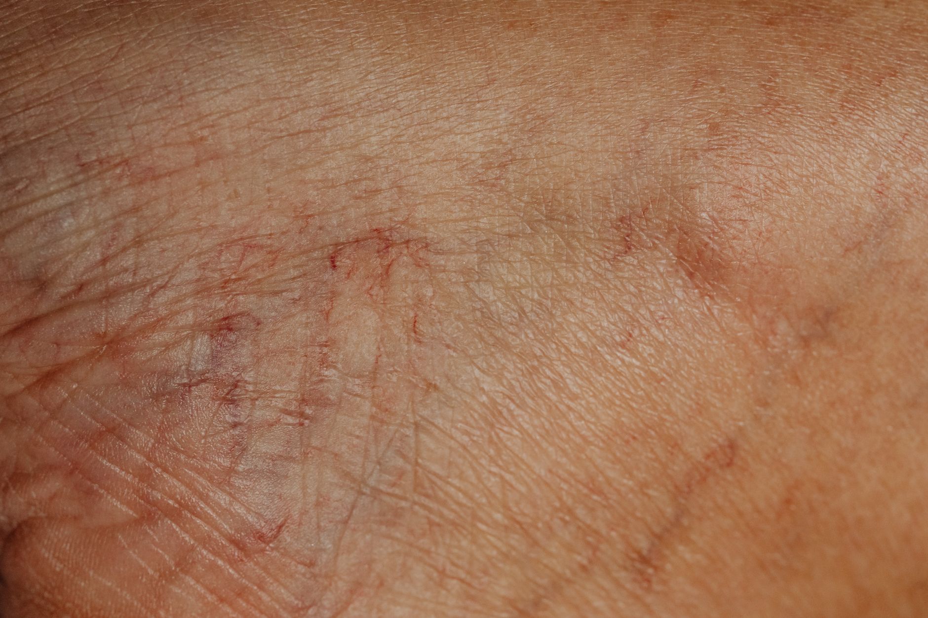 Orticaria: sintomi, cause e rimedi