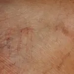 Orticaria: sintomi, cause e rimedi